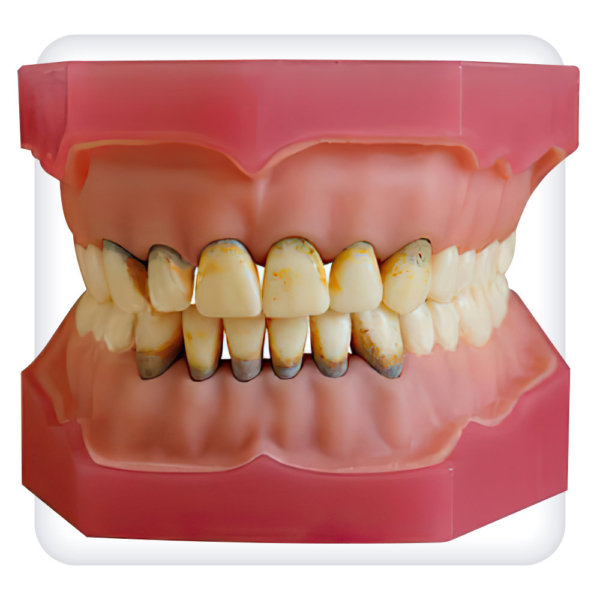 Model of the upper and lower jams with 32 model teeth for periodontal disease treatment